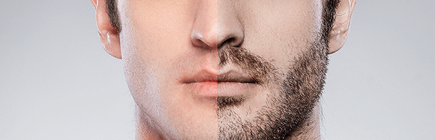 implantar barba