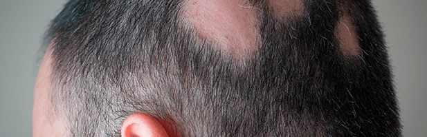 alopecia em clareira